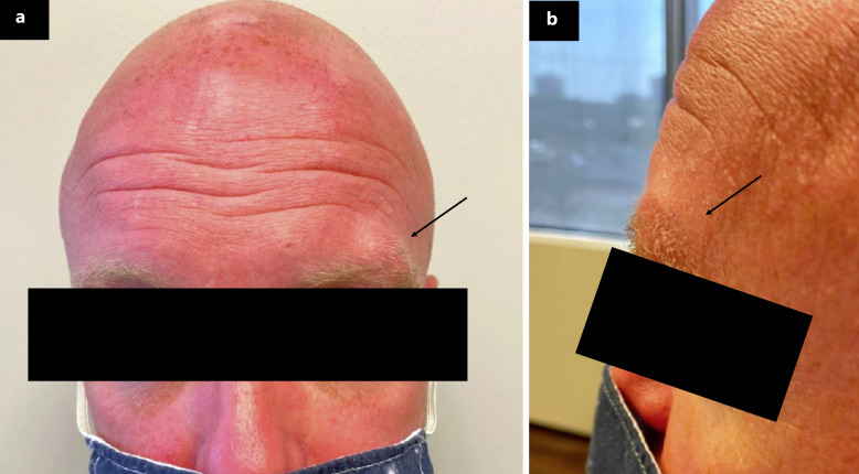 Pilomatrix Carcinoma: A Benign-Mimic with Malignant Consequences - A Case Report and Review of the Current Literature.