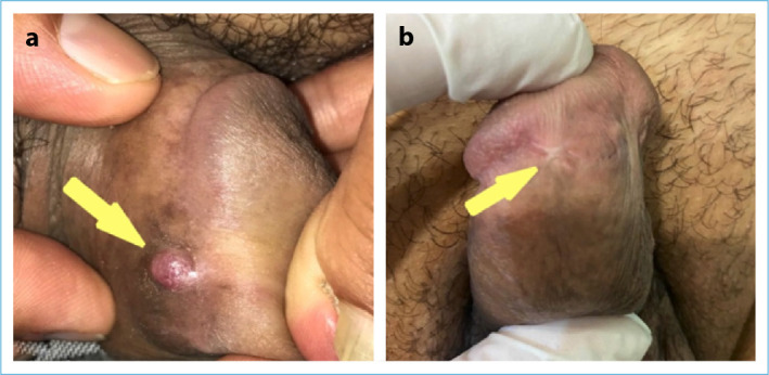 Primary Classic Penile Kaposi's Sarcoma in a Middle Age Circumcised HIV-Negative Patient: Presentation of an Unusual Case.