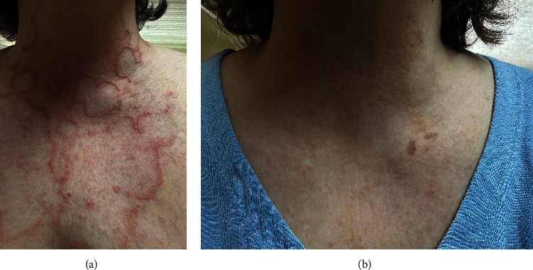 Successful Treatment of Refractory Generalized Granuloma Annulare with Upadacitinib.