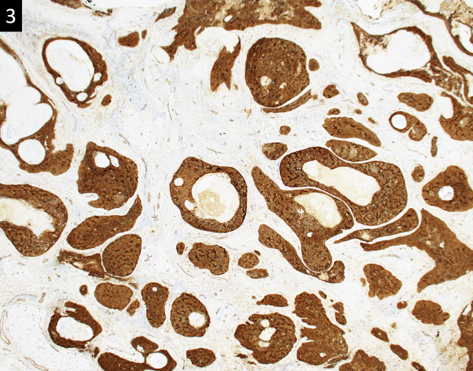 Pilomatrix Carcinoma: A Benign-Mimic with Malignant Consequences - A Case Report and Review of the Current Literature.