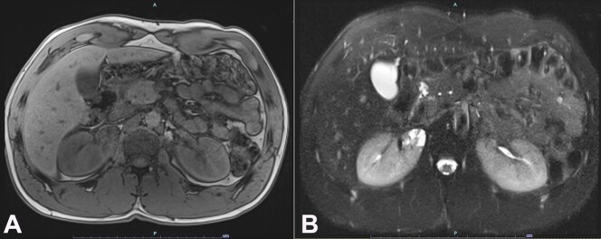 Localized cystic kidney disease: a case report unveiling clinical and histopathological challenges.