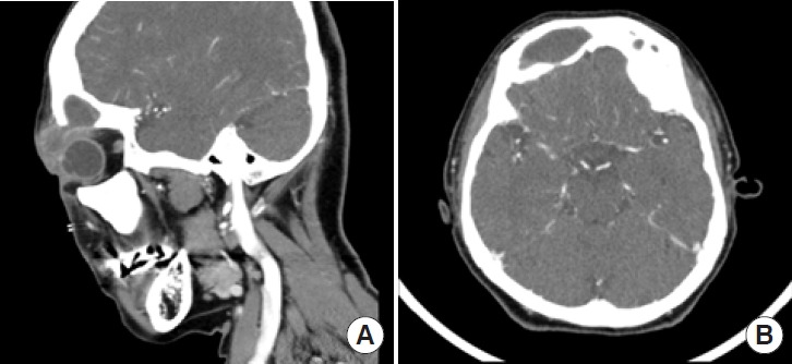 Pott's puffy tumor of the upper eyelid misdiagnosed as simple abscess: a case report and literature review.