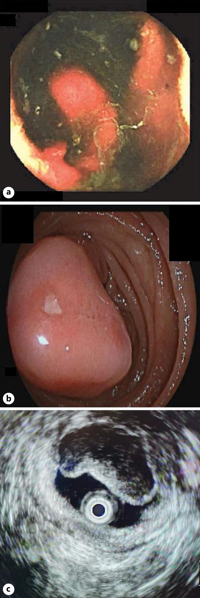 Neurofibromatosis Type 1 Presenting as Bleeding Jejunal Gastrointestinal Stromal Tumour.