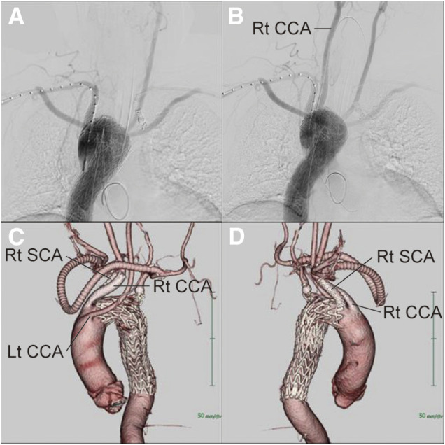 Right Carotid Artery Origin Compression Caused by Endovascular Repair for Kommerell Diverticulum Associated with a Right-Sided Aortic Arch.