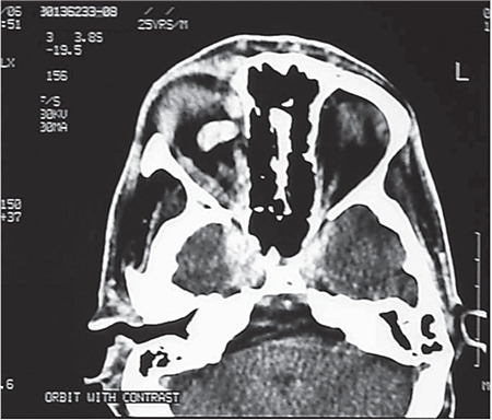 Clinical Presentation of Carotid-Cavernous Fistula and Outcomes of Endovascular Balloon Embolization