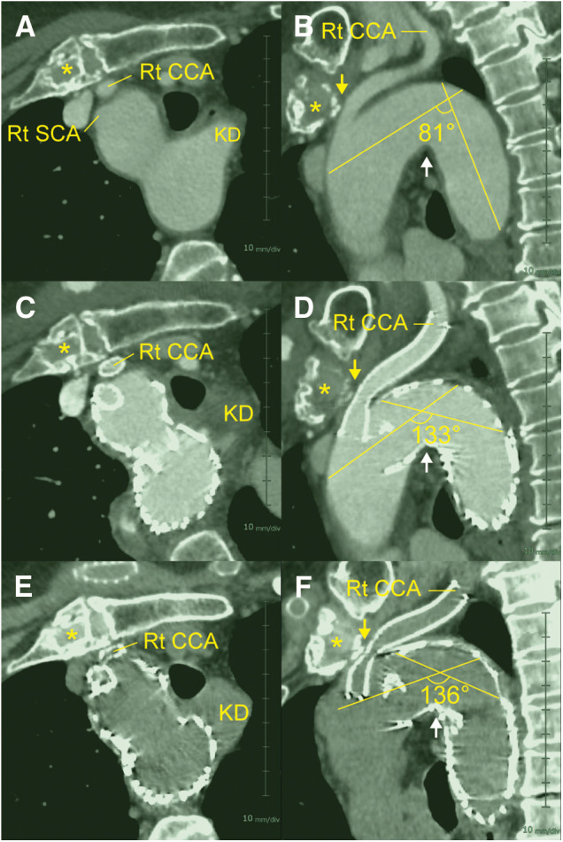 Right Carotid Artery Origin Compression Caused by Endovascular Repair for Kommerell Diverticulum Associated with a Right-Sided Aortic Arch.