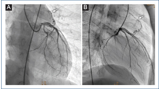 [Double coronary fistula: a rare finding in a pediatric patient].