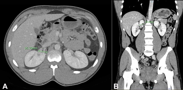 Localized cystic kidney disease: a case report unveiling clinical and histopathological challenges.