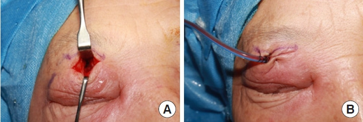 Pott's puffy tumor of the upper eyelid misdiagnosed as simple abscess: a case report and literature review.