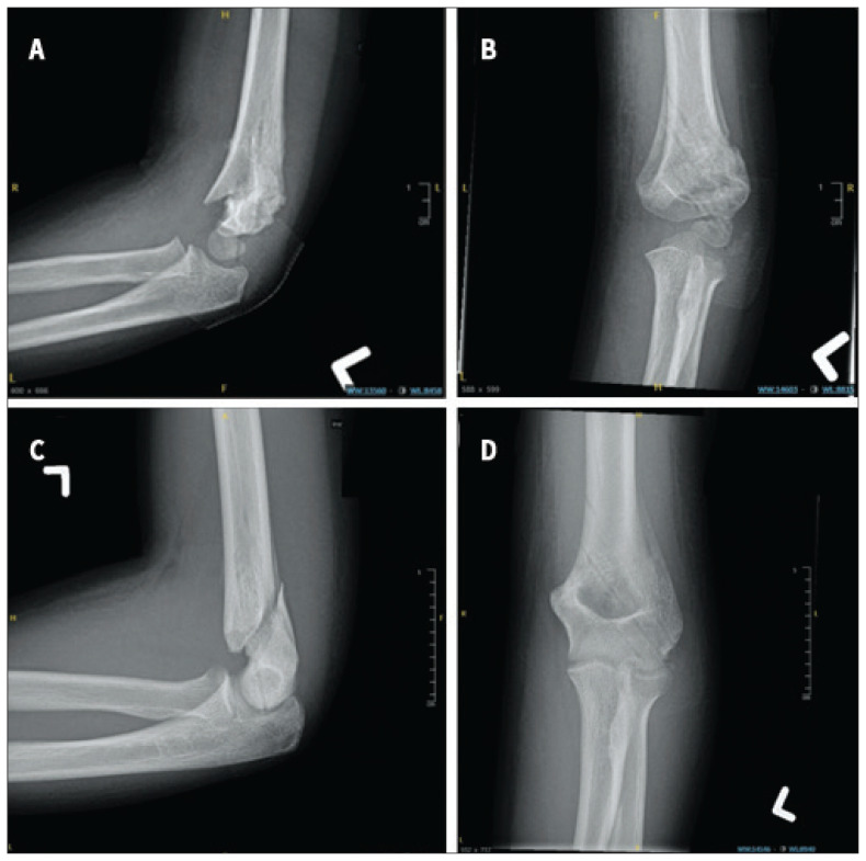 Eliminating rote postoperative radiographs for surgically managed pediatric supracondylar humerus fractures.