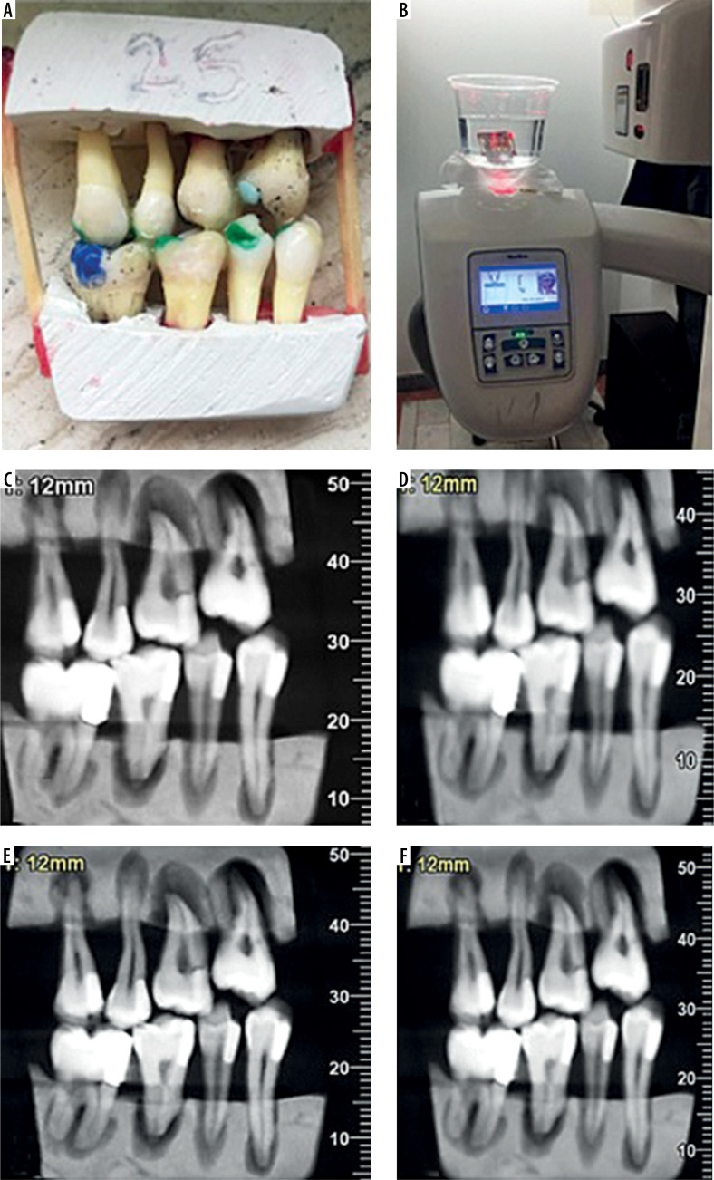 Performance of different cone-beam computed tomography scan modes with and without metal artifact reduction in detection of recurrent dental caries under various restorative materials.