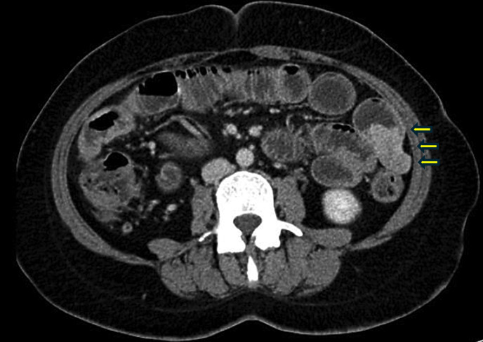Neurofibromatosis Type 1 Presenting as Bleeding Jejunal Gastrointestinal Stromal Tumour.