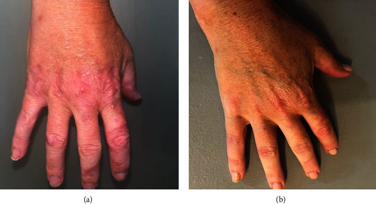 Successful Treatment of Refractory Generalized Granuloma Annulare with Upadacitinib.
