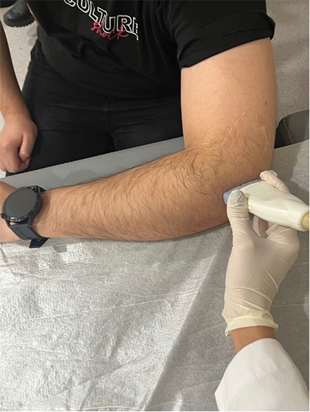 Clinical and Sonographic Evaluation of the Effectiveness of Extracorporeal Shock Wave Therapy in Patients with Lateral Epicondylitis.