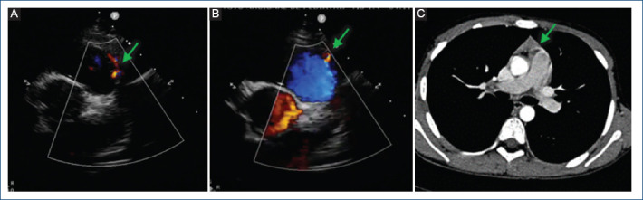 [Double coronary fistula: a rare finding in a pediatric patient].