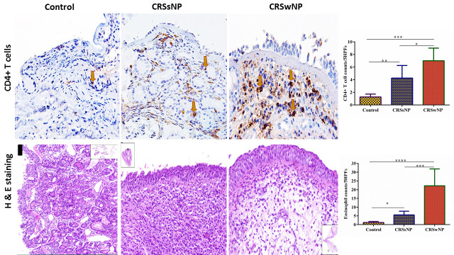 Suppressor of Cytokine Signaling Proteins 3 and 5 Potentially Delineate Polarization of Th cells in Chronic Rhinosinusitis.