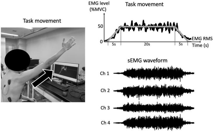 Neural Drive and Motor Unit Characteristics of the Serratus Anterior in Individuals With Scapular Dyskinesis.