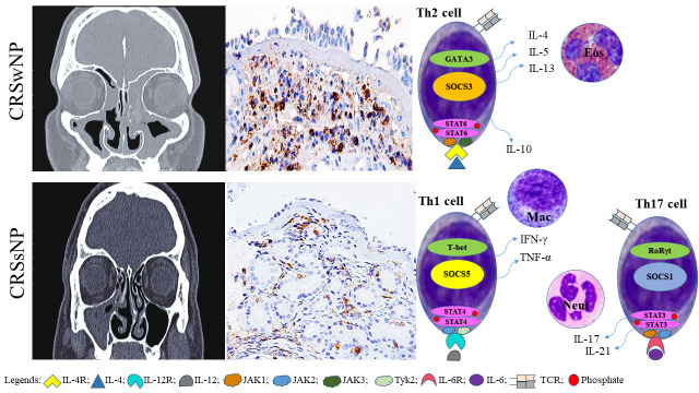Suppressor of Cytokine Signaling Proteins 3 and 5 Potentially Delineate Polarization of Th cells in Chronic Rhinosinusitis.