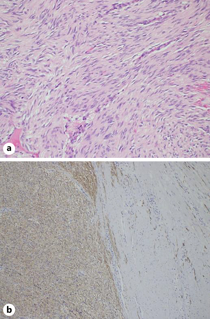 Neurofibromatosis Type 1 Presenting as Bleeding Jejunal Gastrointestinal Stromal Tumour.