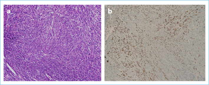 Primary Classic Penile Kaposi's Sarcoma in a Middle Age Circumcised HIV-Negative Patient: Presentation of an Unusual Case.