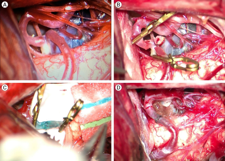 Management of a ruptured posterior inferior cerebellar artery (PICA) aneurysm with end-to-end in situ bypass: Case report.