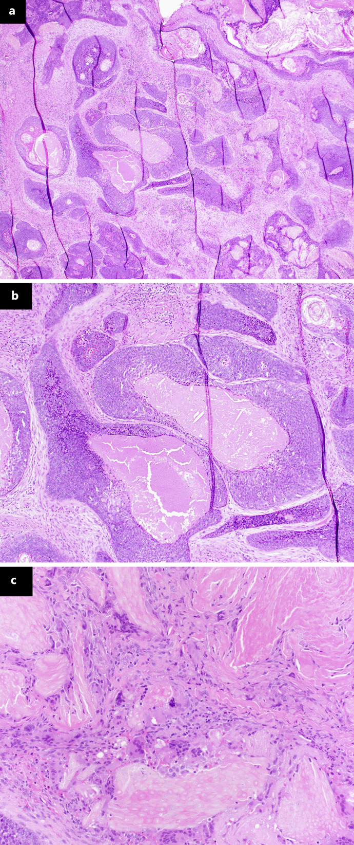 Pilomatrix Carcinoma: A Benign-Mimic with Malignant Consequences - A Case Report and Review of the Current Literature.