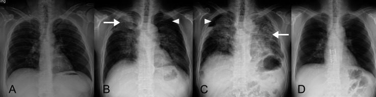Successful lung transplantation for artificial stone-associated accelerated silicosis: a case report.