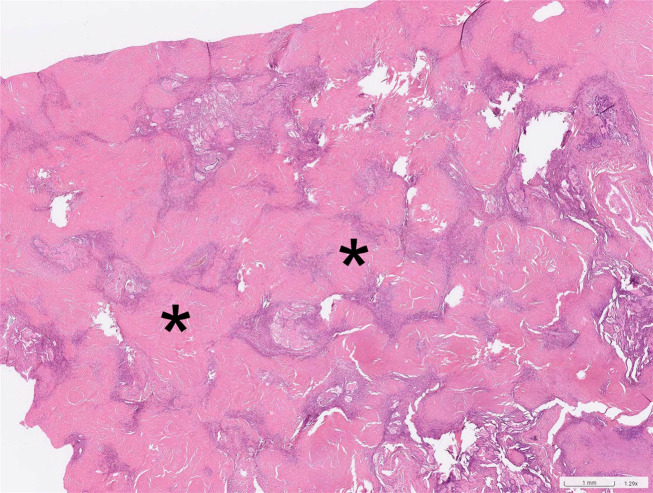 Successful lung transplantation for artificial stone-associated accelerated silicosis: a case report.