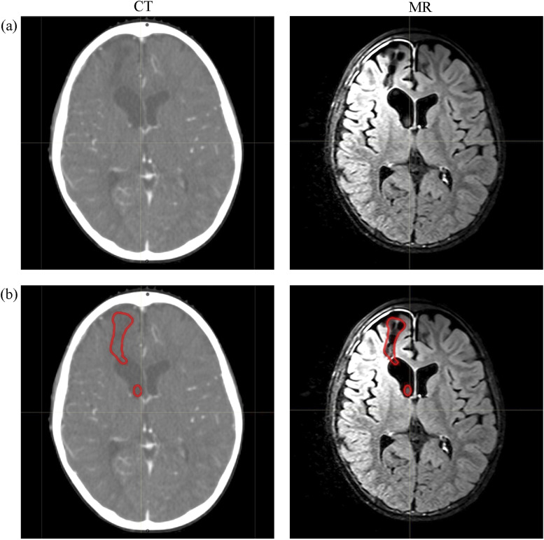 A Review of Artificial Intelligence Application for Radiotherapy.