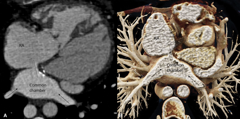 Delayed Presentation of Baffle Obstruction in an Adult Post-Mustard Repair of Transposition: Computed Tomography Demonstration.