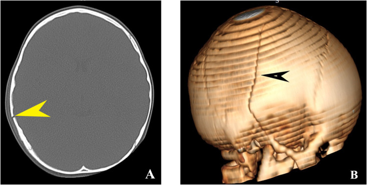 Acute Computer Tomography Findings in Pediatric Accidental Head Trauma-Review.