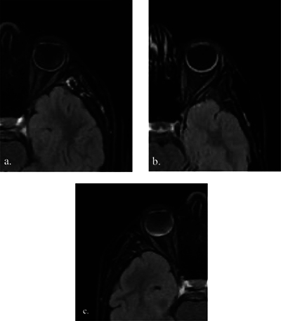 The Diagnostic Utility of Contrast-Enhanced FLAIR Imaging in the Diagnosis of Pediatric Uveitis.