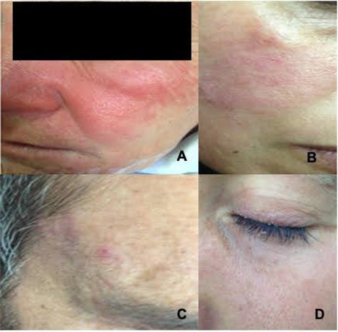 Prevalence and Severity of <i>Demodex folliculorum</i> and <i>Demodex brevis</i> Infestation and Their Association with Common Skin Diseases in Northwest Iran.