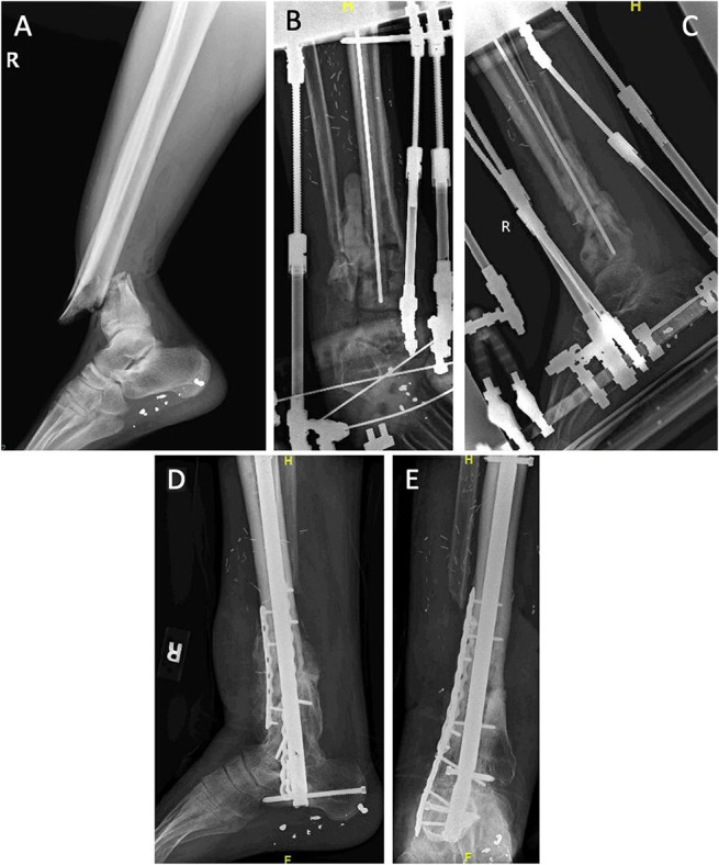 Tibial bone loss.