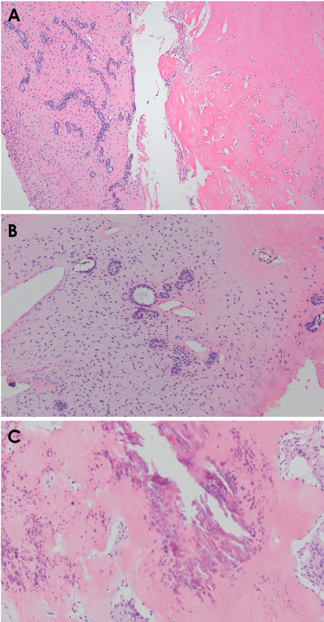 A rare case report of ameloblastic fibrodentinoma with imaging features in a pediatric patient.