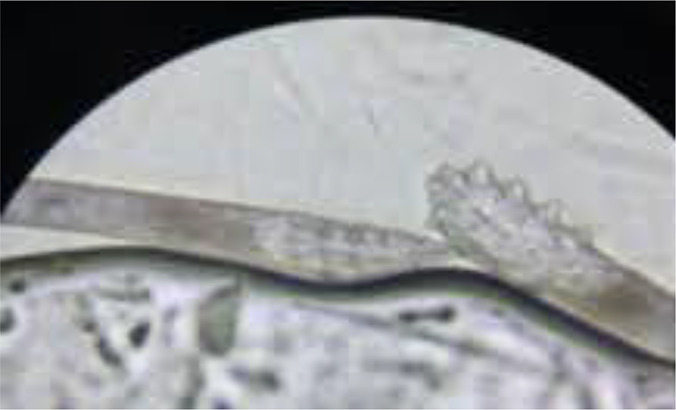 Prevalence and Severity of <i>Demodex folliculorum</i> and <i>Demodex brevis</i> Infestation and Their Association with Common Skin Diseases in Northwest Iran.