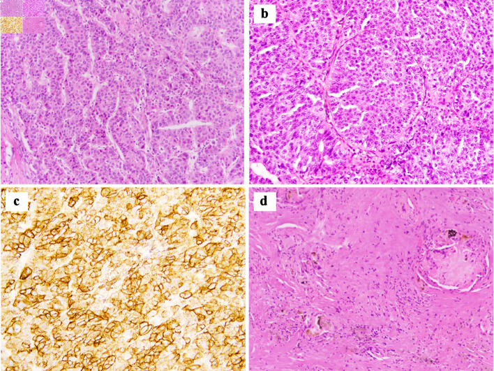 Complete Pathologic Response to Gemcitabine and Oxaliplatin Chemotherapy After Prior Therapies in a Patient With Hepatocellular Carcinoma and Peritoneal Metastases Undergoing Cytoreductive Surgery and Hyperthermic Intraperitoneal Chemotherapy.