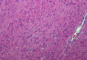 Non-Islet Cell Tumor Hypoglycemia Secondary to a 20 cm Intra-Abdominal Leiomyoma in a Male Patient: A Case Report and Literature Review.