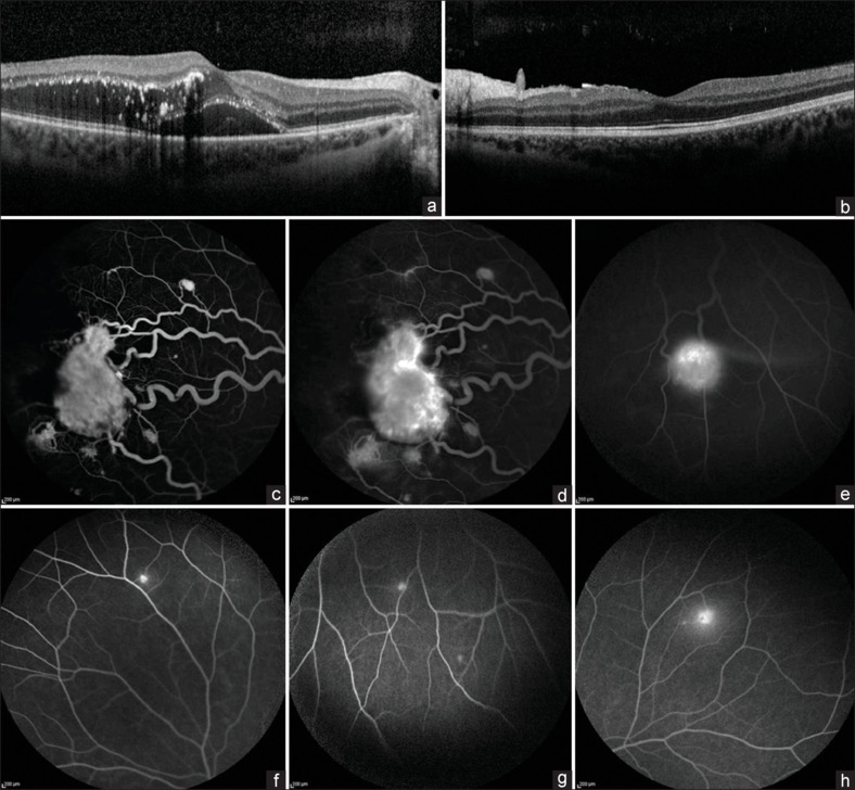 The rare diagnosis of Von Hippel-Lindau disease in a 29-year-old patient.