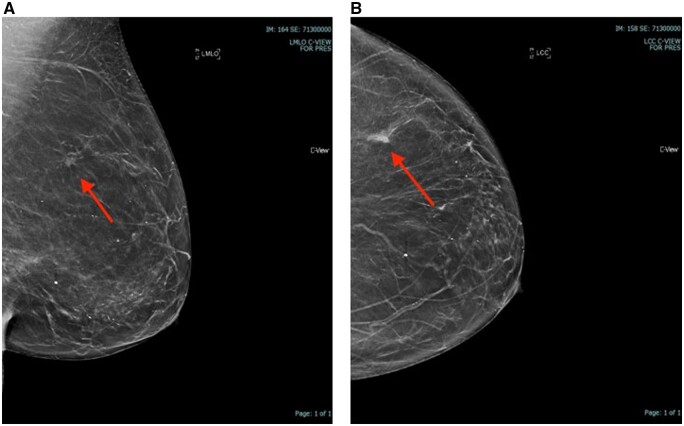 Architectural distortion on digital breast tomosynthesis mammograms in symptomatic breast clinics: what are the result outcomes?
