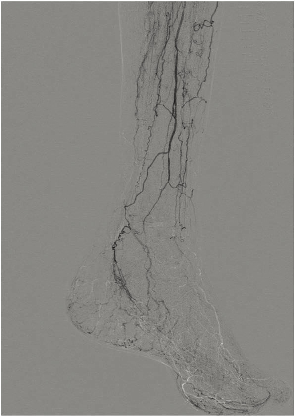 Vascular Disease and Diabetes.