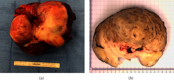 Non-Islet Cell Tumor Hypoglycemia Secondary to a 20 cm Intra-Abdominal Leiomyoma in a Male Patient: A Case Report and Literature Review.
