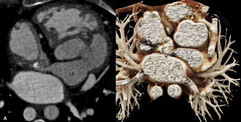 Delayed Presentation of Baffle Obstruction in an Adult Post-Mustard Repair of Transposition: Computed Tomography Demonstration.