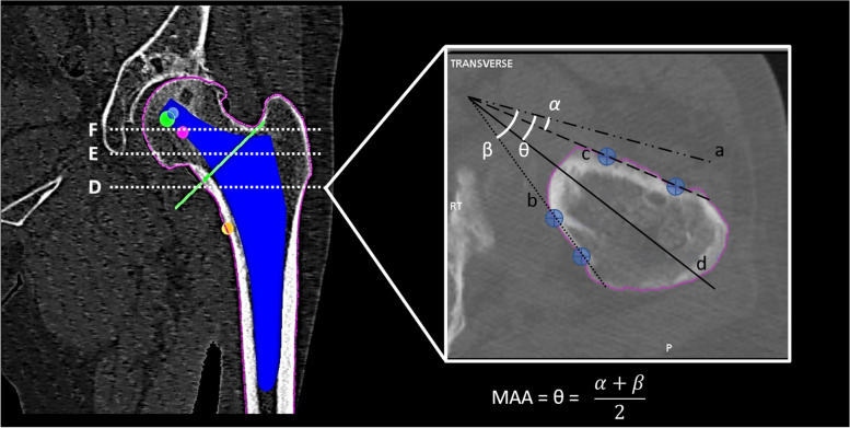 Stem anteversion is not affected by proximal femur geometry in robotic-assisted total hip arthroplasty.