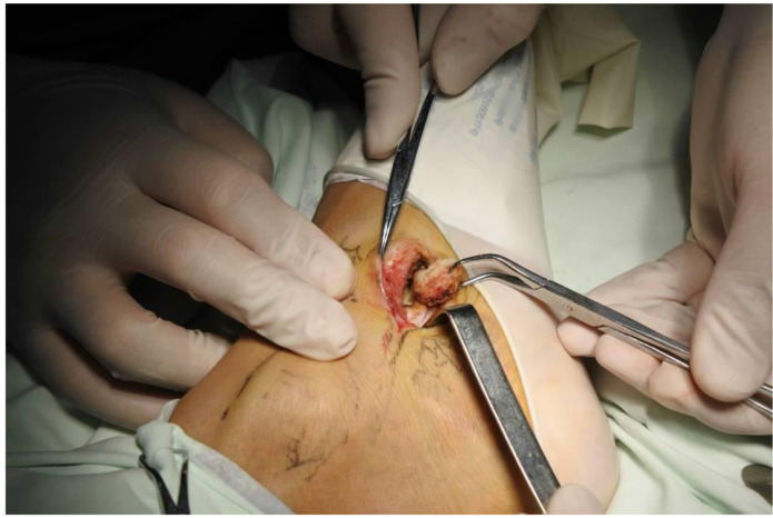 Clinical Effects of Tibial Posterior Tendon Reconstruction in the Treatment of Young Athletes With Accessory Navicular Bone Syndrome.