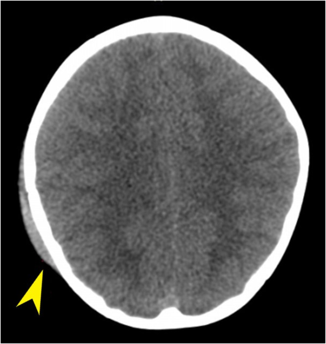 Acute Computer Tomography Findings in Pediatric Accidental Head Trauma-Review.