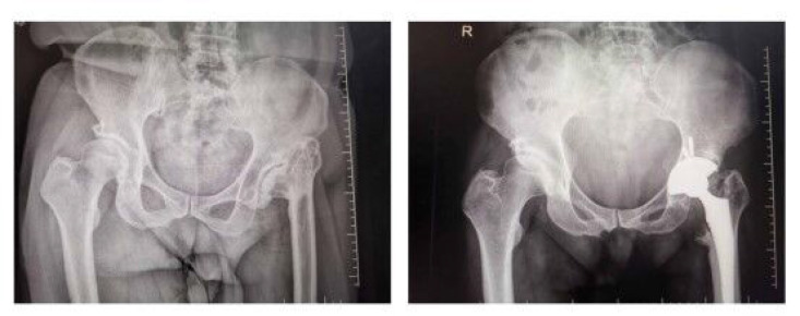 A Comparison Between Fondaparinux Sodium and Low-Molecular-Weight Heparin in Preventing Patients Undergoing Hip Replacement from Deep Vein Thrombosis.