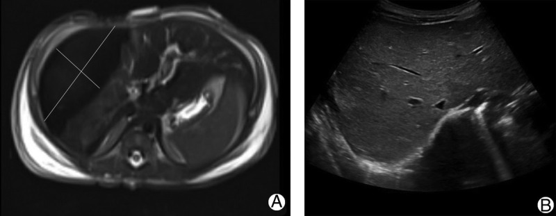 Sudden Collapse of a Newborn Infant Following Delivery Complicated by Shoulder Dystocia.