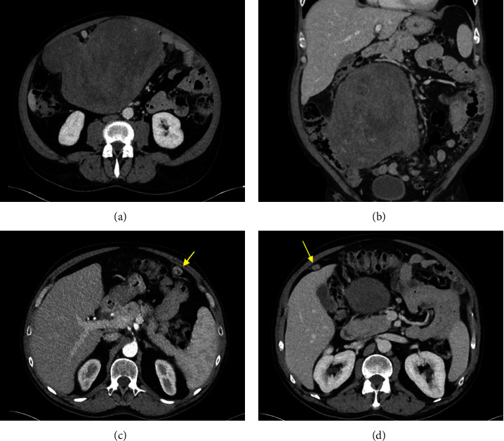 Non-Islet Cell Tumor Hypoglycemia Secondary to a 20 cm Intra-Abdominal Leiomyoma in a Male Patient: A Case Report and Literature Review.
