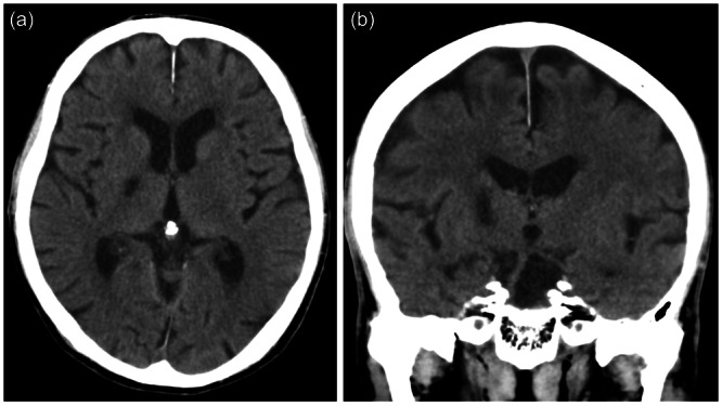 Obsessive-compulsive disorder induced by donepezil in a patient with Alzheimer's disease.